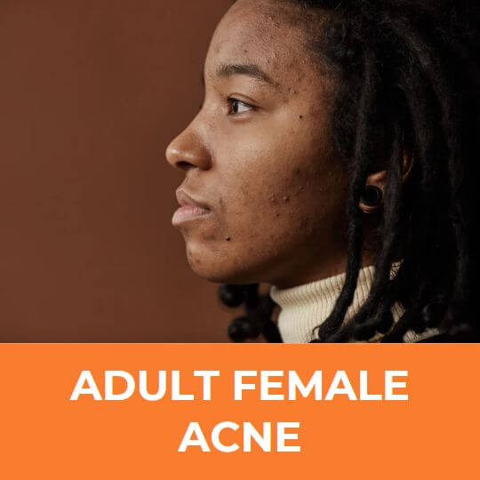 Female aduld acne