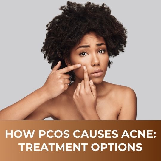 How PCOS Causes Acne: Treatment Options