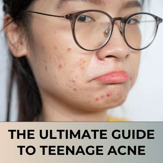 The Ultimate Guide to Teenage Acne