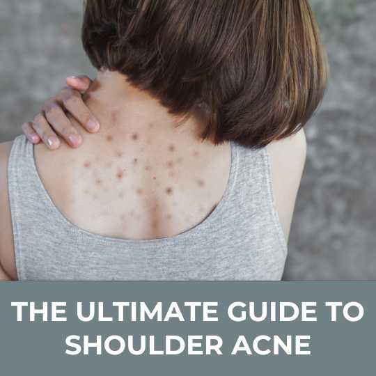 The Ultimate Guide to Shoulder Acne