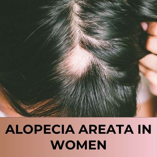 Alopecia Areata in Women