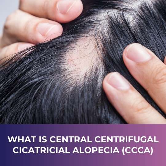 What Is Central Centrifugal Cicatricial Alopecia