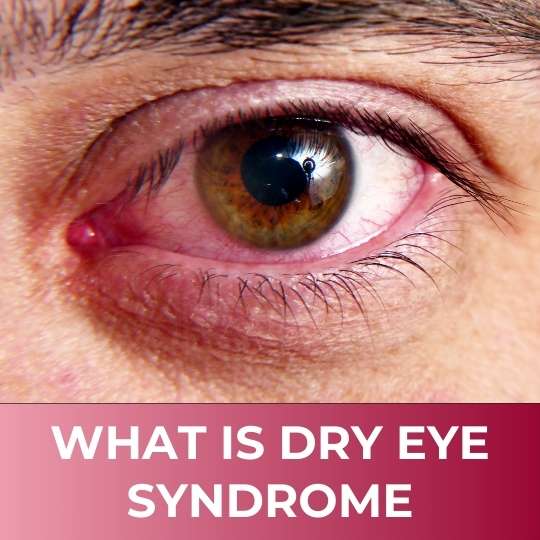 WHAT IS DRY EYE SYNDROME: SYMPTOMS, CAUSES, AND TREATMENTS