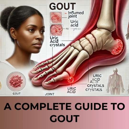 A Complete Guide To Gout