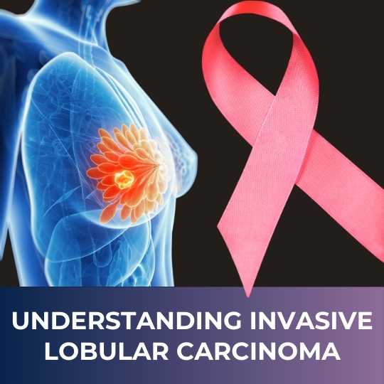 Understanding Invasive Lobular Carcinoma