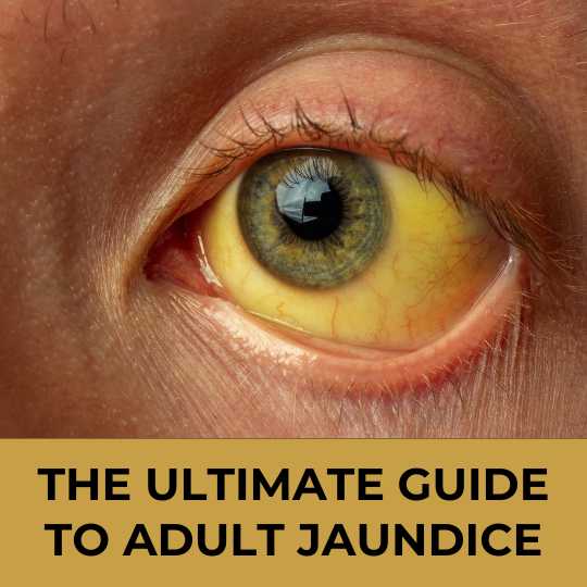 The Ultimate Guide to Adult Jaundice