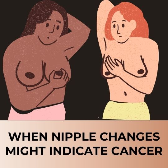 When Nipple Changes Might Indicate Cancer