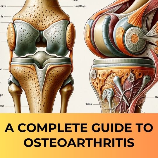 The Ultimate Guide to Osteoarthritis