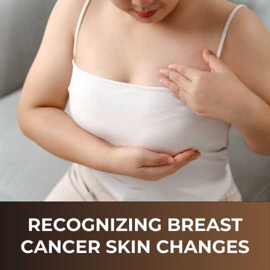 Recognizing Breast Cancer Skin Changes