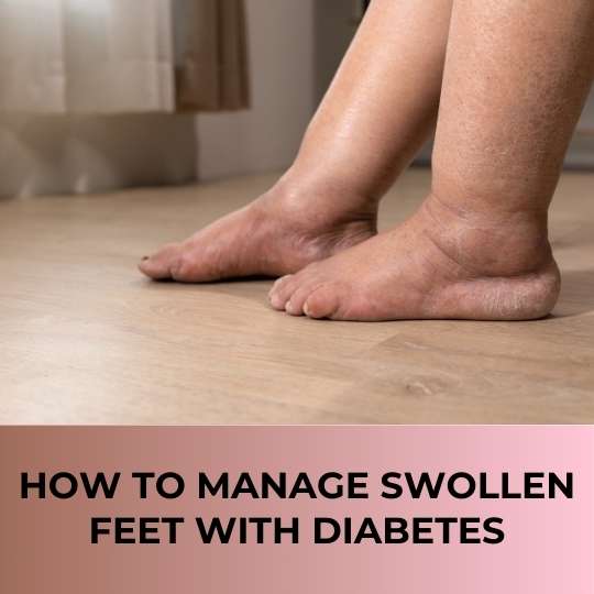 How to Manage Swollen Feet with Diabetes